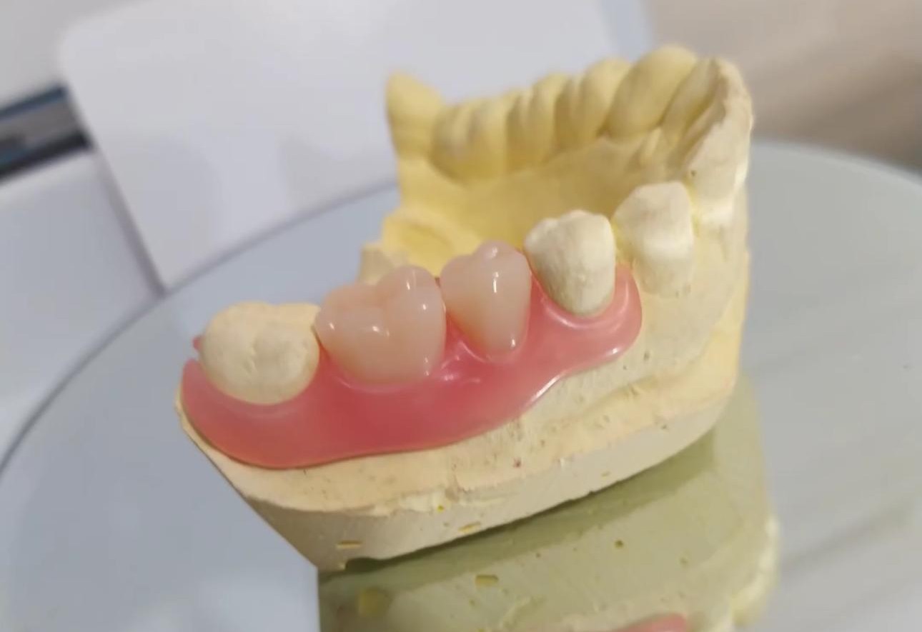 denture